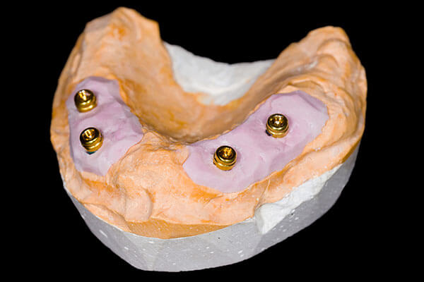 Four implants in clay model